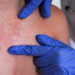 Alerta-por-sarampion-en-Norteamerica-Mexico-lidera-contagios-y-EE.UU_.-refuerza-vigilancia-sanitaria-shutterstock_2673911455 (1)l