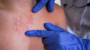 Alerta-por-sarampion-en-Norteamerica-Mexico-lidera-contagios-y-EE.UU_.-refuerza-vigilancia-sanitaria-shutterstock_2673911455 (1)l